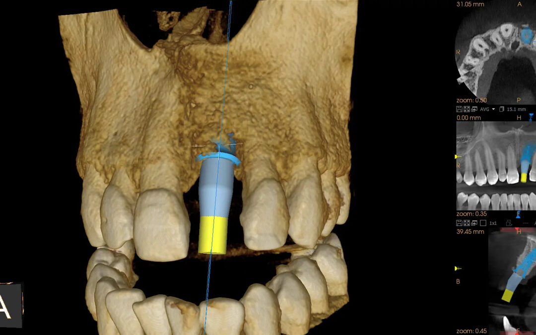 TAC 3D (CBCT)